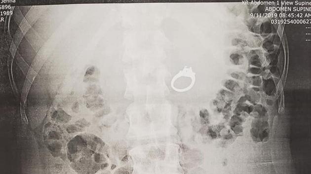 An X-ray sure enough confirmed that she had swallowed the ring.(Facebook/Jenna Evans)