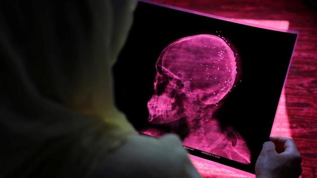 Rubina shows Irshad’s x-ray. “If he has to go out for a change of bandage to the nearby government hospital, he will be accompanied by six or seven women, so they don’t snatch him away,” Rubina said. (Danish Siddiqui / REUTERS)