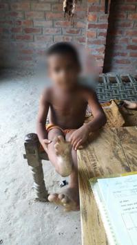 A child of Sidhauli in Sitapur district was reportedly forced to walk on burning coals when some bluish marks appeared on his body. (HT) A child of Sidhauli in Sitapur district was reportedly forced to walk on burning coals when some bluish marks appeared on his body. (HT)