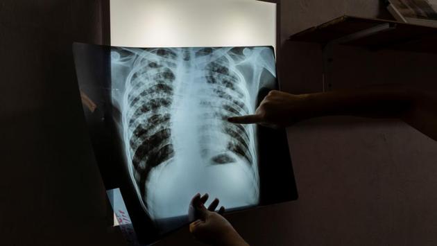 Mariela, an infectious disease specialist intern, analyses an X-ray of 24-year-old patient Jorge, who is currently undergoing treatment for tuberculosis. According to the latest figures from the WHO, there were 10,320 reports of new and relapsed TB cases in Argentina last year. The number of cases, which had dropped steadily since the 1980s, started to rise again after around 2010. (Magali Druscovich / REUTERS) Mariela, an infectious disease specialist intern, analyses an X-ray of 24-year-old patient Jorge, who is currently undergoing treatment for tuberculosis. According to the latest figures from the WHO, there were 10,320 reports of new and relapsed TB cases in Argentina last year. The number of cases, which had dropped steadily since the 1980s, started to rise again after around 2010. (Magali Druscovich / REUTERS)