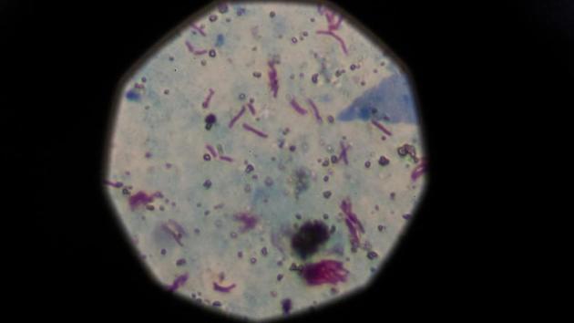 A sample that tested positive for tuberculosis is seen from a microscope. “Due to overcrowding, the hospital is discharging patients with low risk of contagion in order to receive high-risk ones, something very dangerous,” Figueroa said, adding that the hospital was looking at how to add more beds to other wards to accept more people. (Magali Druscovich / REUTERS) A sample that tested positive for tuberculosis is seen from a microscope. “Due to overcrowding, the hospital is discharging patients with low risk of contagion in order to receive high-risk ones, something very dangerous,” Figueroa said, adding that the hospital was looking at how to add more beds to other wards to accept more people. (Magali Druscovich / REUTERS)