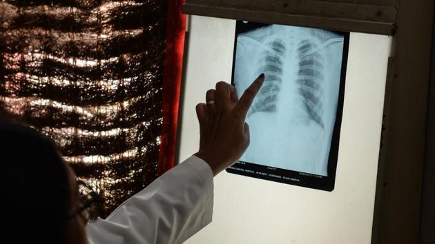 A doctor checks the chest X-ray of a patient in the tuberculosis (TB) department of the government-run Osmania General Hospital in Hyderabad. Scientists said they are closing in on a vaccine for tuberculosis, the world’s deadliest infectious disease that claimed some 1.5 million lives last year. (Noah Seelam / AFP)