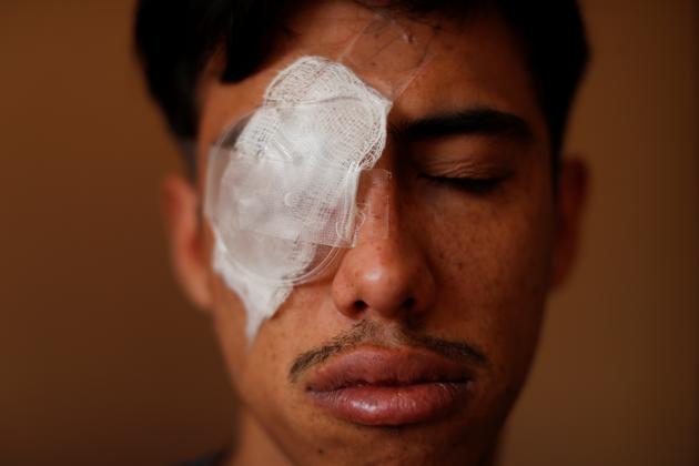 Jean Espinoza, 22, poses for a photograph inside Christopher Astudillo's (not pictured) hotel room in Santiago. Espinoza's eye was hit with a pellet during a protest in his hometown of Iquique in October. After three days of waiting, he was eventually transferred to the ocular trauma unit at the Hospital del Salvador in Santiago where he was then diagnosed with sight-loss in one of his eyes. (Jorge Silva / REUTERS) Jean Espinoza, 22, poses for a photograph inside Christopher Astudillo's (not pictured) hotel room in Santiago. Espinoza's eye was hit with a pellet during a protest in his hometown of Iquique in October. After three days of waiting, he was eventually transferred to the ocular trauma unit at the Hospital del Salvador in Santiago where he was then diagnosed with sight-loss in one of his eyes. (Jorge Silva / REUTERS)