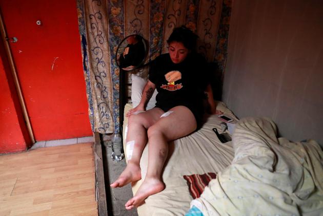 Camila Miranda, a demonstrator who was injured during a protest. “We don’t mind being hungry, facing hardship, neglect, pain,” she said. “People are willing to make a sacrifice to achieve real change.” (Henry Romero / REUTERS) Camila Miranda, a demonstrator who was injured during a protest. “We don’t mind being hungry, facing hardship, neglect, pain,” she said. “People are willing to make a sacrifice to achieve real change.” (Henry Romero / REUTERS)