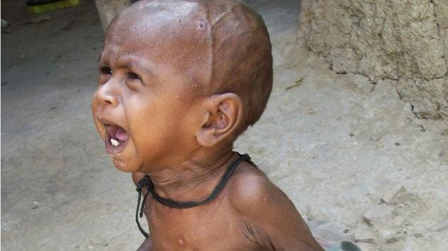 Malnourished children earn 20% less as adults than other children(HT FILE PHOTO)