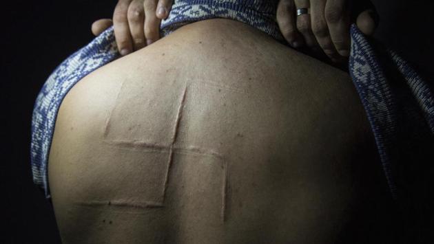 Bogdan Sergiets, former resident of Donetsk, shows a swastika scar on his back. Sergiets was captured by Russia-backed rebels in his workplace in Donetsk, he spent 10 hours in captivity, tortured and beaten, and his captors engraved the swastika on his back. Civilians who went through captivity say that there is effectively no support system for them — once released, they are on their own with their injuries, psychological traumas and financial hardships. (Zoya Shu / AP)