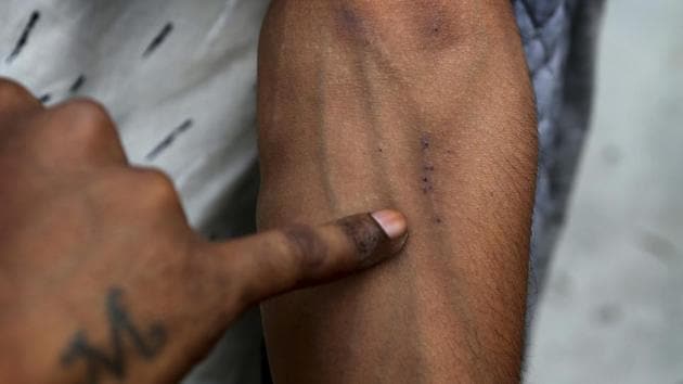 A recovering addict shows his veins at a de-addiction centre. Hordes of people rushed in, seeking help in managing excruciating withdrawal. For some, tramadol had become as essential as food. “Like if you don’t eat, you start to feel hungry. Similar is the case with not taking it,” said auto shop welder Deepak Arora, a gaunt 30-year-old who took 15 tablets day, so much he had to steal from his family to pay for pills. “You are like a dead person.” (Channi Anand / AP)
