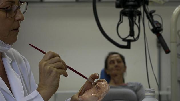 Researchers at Paulista University are employing smartphones and 3D printing to create digital facial impressions used to make silicone prostheses. The method has slashed costs and halved production times. “In the past, it took much longer work, hours of sculpting by hand, and the process was very invasive, with material on the patient’s face to get an imprint of their appearance,” said Rodrigo Salazar, the lead researcher. (Miguel Schincariol/AFP) Researchers at Paulista University are employing smartphones and 3D printing to create digital facial impressions used to make silicone prostheses. The method has slashed costs and halved production times. “In the past, it took much longer work, hours of sculpting by hand, and the process was very invasive, with material on the patient’s face to get an imprint of their appearance,” said Rodrigo Salazar, the lead researcher. (Miguel Schincariol/AFP)