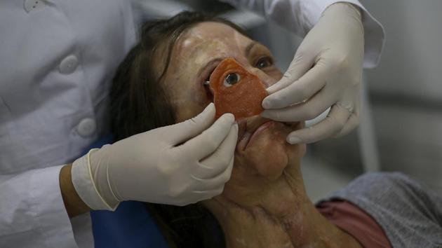 A doctor tests an eye implant on Vicentin. Her ordeal began 30 years ago when she developed a facial tumour. Removed twice, it returned as malignant two decades later. Gradually, she lost parts of her face. “When I was on the metro or train, I tried not to pay attention to the stares,” she recalled. “At places like the bowling alley, I felt them looking, and the person would even leave when they saw me.” (Miguel Schincariol/AFP) A doctor tests an eye implant on Vicentin. Her ordeal began 30 years ago when she developed a facial tumour. Removed twice, it returned as malignant two decades later. Gradually, she lost parts of her face. “When I was on the metro or train, I tried not to pay attention to the stares,” she recalled. “At places like the bowling alley, I felt them looking, and the person would even leave when they saw me.” (Miguel Schincariol/AFP)