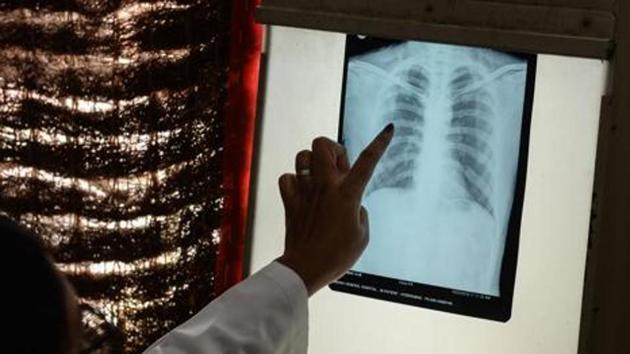 The World Health Organisation (WHO) has set a target of eradicating TB from the world by 2035, while India has set a target of 2025 (PICTURE FOR REPRESENTATIONAL PURPOSES ONLY) The World Health Organisation (WHO) has set a target of eradicating TB from the world by 2035, while India has set a target of 2025 (PICTURE FOR REPRESENTATIONAL PURPOSES ONLY)