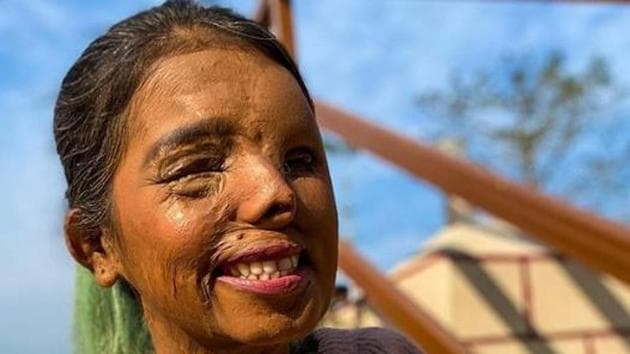 Acid attack survivor Anmol Rodrigues is an active social media user.(Instagram)