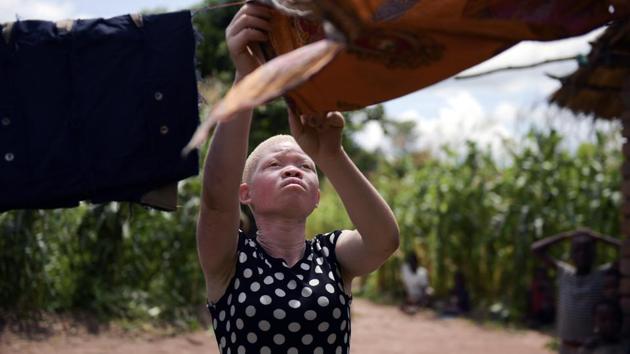 Catherine Amidu hangs clothes to dry outside her home in Machinga, Malawi. People with albinism in several African countries live in fear of being abducted and killed in the mistaken belief that their body parts carry special powers and can be sold for thousands of dollars. 17-year-old Amidu has survived an attempt on her life in 2017. (Thoko Chikondi / AP) Catherine Amidu hangs clothes to dry outside her home in Machinga, Malawi. People with albinism in several African countries live in fear of being abducted and killed in the mistaken belief that their body parts carry special powers and can be sold for thousands of dollars. 17-year-old Amidu has survived an attempt on her life in 2017. (Thoko Chikondi / AP)