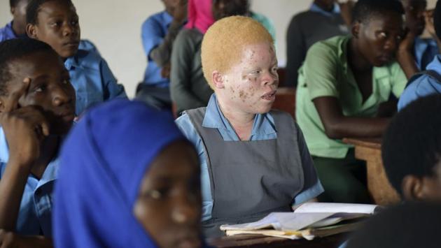 Mina Godfrey attends class at the Nsanjama Private Primary School. The southern African nation has more than 134,000 people with albinism, representing 0.8% of the total population, according to the national statistics office in 2018. (Thoko Chikondi / AP) Mina Godfrey attends class at the Nsanjama Private Primary School. The southern African nation has more than 134,000 people with albinism, representing 0.8% of the total population, according to the national statistics office in 2018. (Thoko Chikondi / AP)
