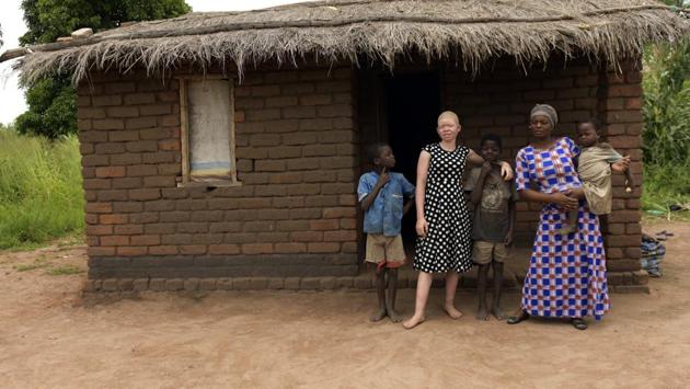 Inspector Chance Chifumbi, the community policing officer for Malawi’s southern region, said access to batteries that power the alarms is the main problem. In an effort to provide further security for children with albinism, the Association of Persons with Albinism has been helping to send them to boarding schools by finding donors to pay for their school fees. (Thoko Chikondi / AP) Inspector Chance Chifumbi, the community policing officer for Malawi’s southern region, said access to batteries that power the alarms is the main problem. In an effort to provide further security for children with albinism, the Association of Persons with Albinism has been helping to send them to boarding schools by finding donors to pay for their school fees. (Thoko Chikondi / AP)