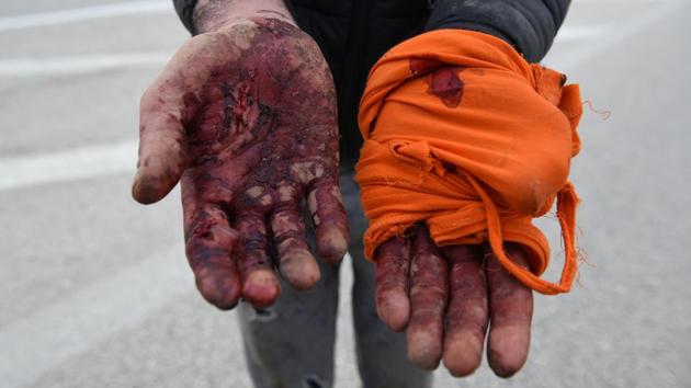 A migrant from Afghanistan demonstrates his hands that were injured in his effort to cross from Turkey into Greece. At the Pazarkule border post with Greece, scores of migrants faced barbed wire fences and smoke grenades. Some stuck in the no-man’s land between the two countries tried to return to the Turkish side, only to be turned back by Turkish authorities. (Alexandros Avramidis / REUTERS) A migrant from Afghanistan demonstrates his hands that were injured in his effort to cross from Turkey into Greece. At the Pazarkule border post with Greece, scores of migrants faced barbed wire fences and smoke grenades. Some stuck in the no-man’s land between the two countries tried to return to the Turkish side, only to be turned back by Turkish authorities. (Alexandros Avramidis / REUTERS)