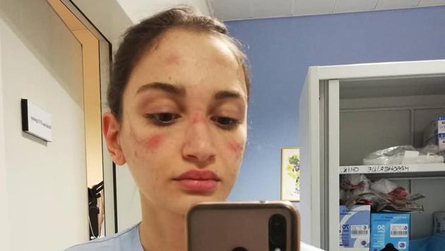 Nurse Alessia Bonari has posted a selfie of herself that shows her face bruised by the mask she has to wear while working. (Instagram/alessiabonari_/) Nurse Alessia Bonari has posted a selfie of herself that shows her face bruised by the mask she has to wear while working. (Instagram/alessiabonari_/)