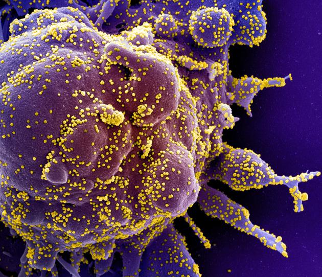 Colorized scanning electron micrograph of an apoptotic cell (purple) infected with SARS-COV-2 virus particles (yellow), also known as novel coronavirus, isolated from a patient sample. (via REUTERS) Colorized scanning electron micrograph of an apoptotic cell (purple) infected with SARS-COV-2 virus particles (yellow), also known as novel coronavirus, isolated from a patient sample. (via REUTERS)