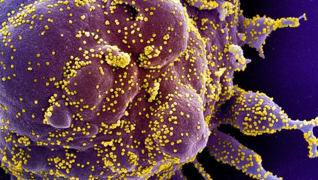 Colorized scanning electron micrograph of an apoptotic cell (purple) infected with SARS-COV-2 virus particles (yellow), also known as novel coronavirus, isolated from a patient sample. (REUTERS) Colorized scanning electron micrograph of an apoptotic cell (purple) infected with SARS-COV-2 virus particles (yellow), also known as novel coronavirus, isolated from a patient sample. (REUTERS)