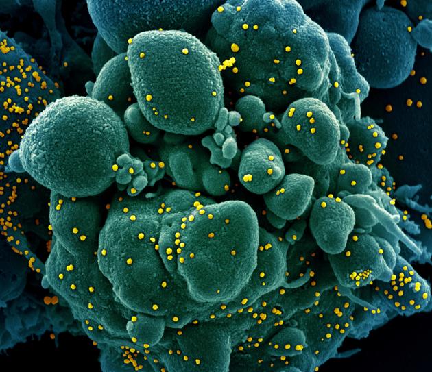 Colorized scanning electron micrograph of an apoptotic cell (green) infected with SARS-COV-2 virus particles (yellow), also known as novel coronavirus, isolated from a patient sample.(REUTERS)