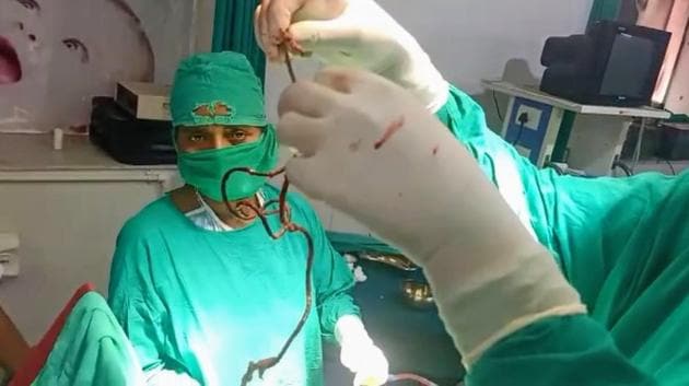 The general surgeon of the hospital, Dr Sunil Kumar, performed the surgery, which took around one hour.(HT Photo)