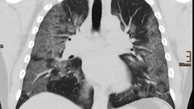 A CT scan picture shows lungs of 48-year-old coronavirus disease patient Andre Bergmann, in this screen grab released on April 14, 2020 by the Bethanien Hospital lung clinic in Moers, Germany.(REUTERS)