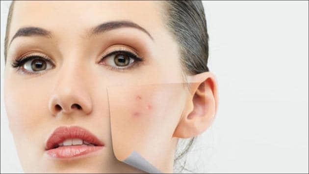 5 overnight quick-fix home remedies to cure pimples(Twitter/EscuelaOmnilife)