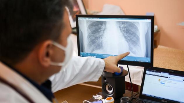 Based on the analysis of the study, the researchers identified proteins and pathways of molecules in lung cells whose levels change upon infection by the coronavirus. (AFP photo for representation) Based on the analysis of the study, the researchers identified proteins and pathways of molecules in lung cells whose levels change upon infection by the coronavirus. (AFP photo for representation)