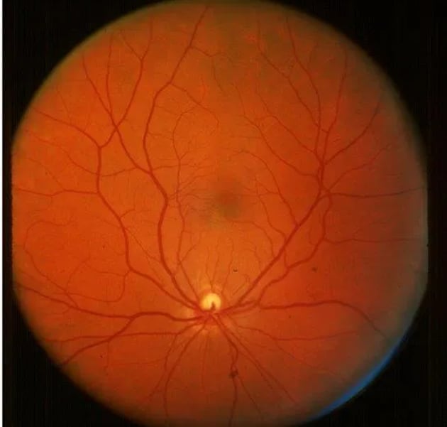 Scientists have shown that routine eye imaging can identify changes in the retina that may be associated with cognitive disorders in older people with type 1 diabetes.(Yahoo)