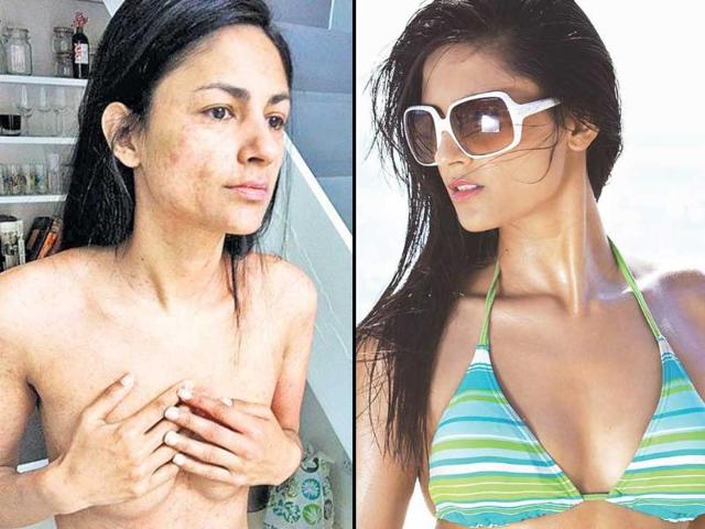 Aruna Shields did not think twice before posting a repulsive nude pic while she was down with measles.