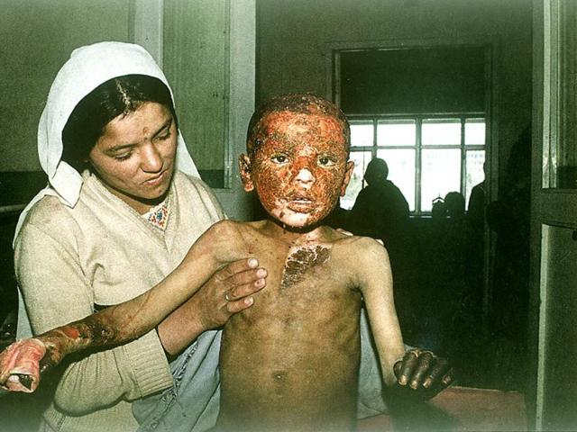April 1989: A young burn victim is treated at Kabul's Jamhuriyat Hospital. (Robert Nickelsberg)