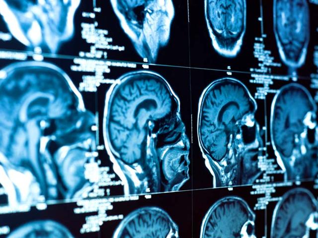 Images-from-a-brain-scan-Shutterstock-image