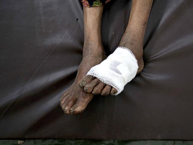 The wounded feet of a man after an earthquake hit Nepal. (Burhaan Kinu / HT Photo)