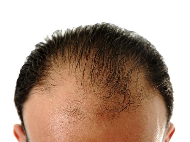 Stress, pollution, poor nutrition and disrupted sleep patterns are key reasons behind premature baldness, which is a problem plaguing people as early as in their twenties. A noteworthy solution, an expert says, lies in hair restoration -- a market growing at a rapid pace. (Shutterstock Photo)