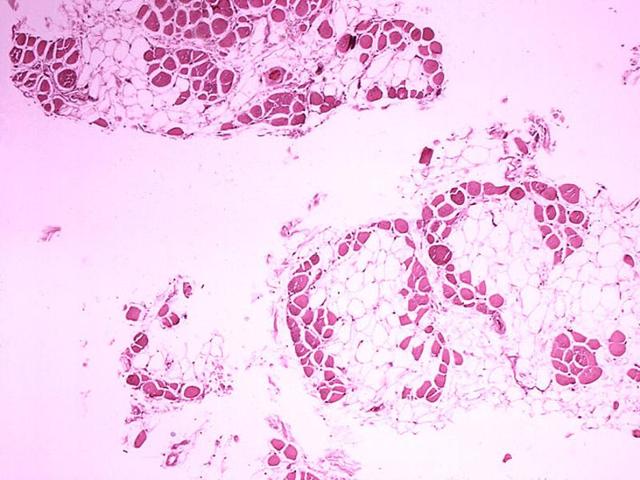 Histopathology of gastrocnemius muscle from patient who died of pseudohypertrophic muscular dystrophy, Duchenne type. Cross section of muscle shows extensive replacement of muscle fibers by adipose cells. Histopathology of gastrocnemius muscle from patient who died of pseudohypertrophic muscular dystrophy, Duchenne type. Cross section of muscle shows extensive replacement of muscle fibers by adipose cells.