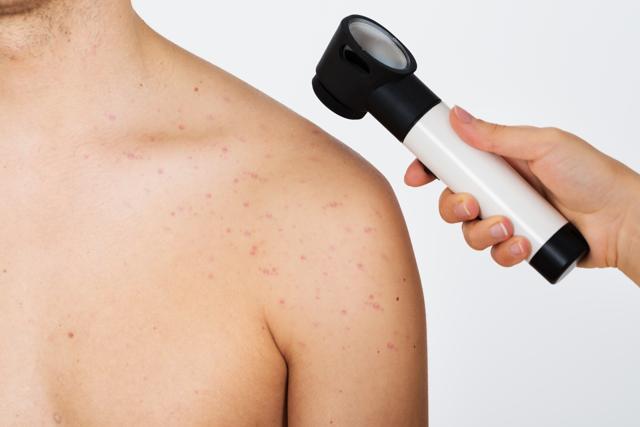 “Don’t just look at your arms -- melanoma can develop anywhere on the body, and is most common on the trunk in men and the legs in women,” say the researchers. (Shutterstock) “Don’t just look at your arms -- melanoma can develop anywhere on the body, and is most common on the trunk in men and the legs in women,” say the researchers. (Shutterstock)