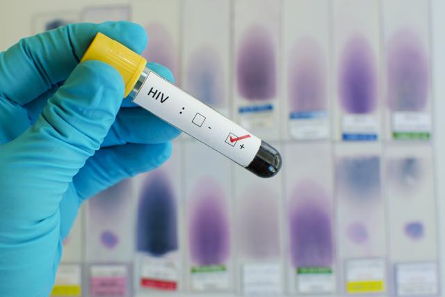 Get tested four-six weeks after exposure for accurate diagnosis. (Shutterstock) Get tested four-six weeks after exposure for accurate diagnosis. (Shutterstock)