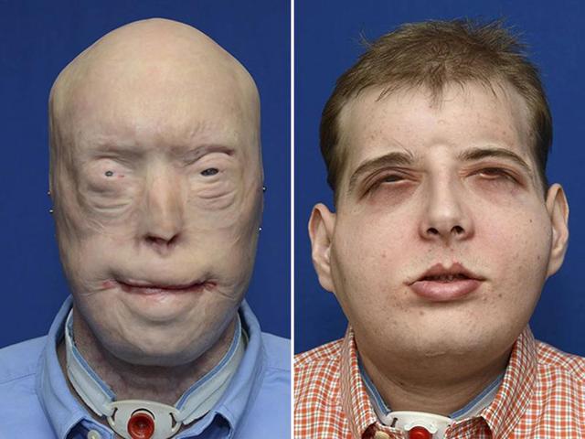 Volunteer firefighter Patrick Hardison, 41, of Senatobia, Mississippi is shown in this composite photo showing before-and-after face transplant surgery in this undated handout provided by NYU Langone Medical Center n New York. (Reuters) Volunteer firefighter Patrick Hardison, 41, of Senatobia, Mississippi is shown in this composite photo showing before-and-after face transplant surgery in this undated handout provided by NYU Langone Medical Center n New York. (Reuters)
