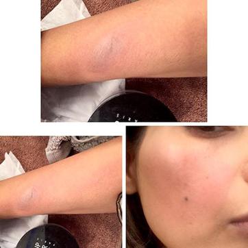 Bipasha shared pictures of her burned arms and face on Twitter. (Twitter screenshot) Bipasha shared pictures of her burned arms and face on Twitter. (Twitter screenshot)