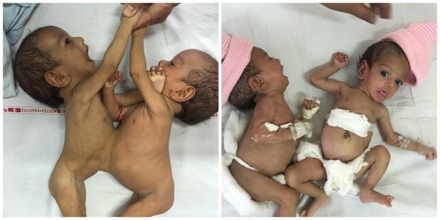 On the complexity of such surgeries, Dr Kanojia said, “The complexity of such surgeries varies from case to case. It depends on the number of organs shared by the twins, if there are many organs then it becomes more difficult and surgeons may have to choose survival of one of the two babies.” (HT Photo) On the complexity of such surgeries, Dr Kanojia said, “The complexity of such surgeries varies from case to case. It depends on the number of organs shared by the twins, if there are many organs then it becomes more difficult and surgeons may have to choose survival of one of the two babies.” (HT Photo)