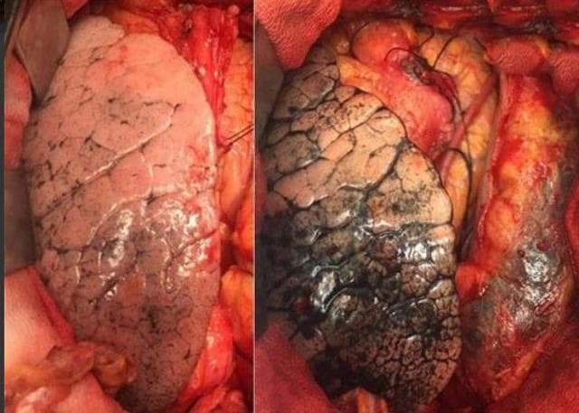 One pair of lungs belong to a 55-year-old person from Himachal Pradesh and the other was that of a 52-year-old person in Delhi(Kejriwal’s Twitter Handle)