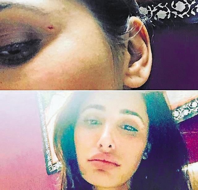 Nargis Fakhri shows us her battle scars. (Instagram) Nargis Fakhri shows us her battle scars. (Instagram)