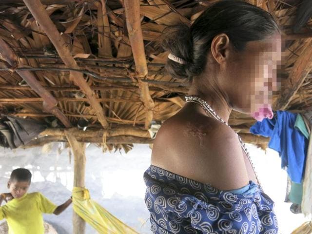 Peddagellur residents PL and her daughter-in-law were assaulted and gangraped. PL was assaulted with rifles on her right shoulder, and sustains this injury.(Chitrangada Choudhury/HT Photo) Peddagellur residents PL and her daughter-in-law were assaulted and gangraped. PL was assaulted with rifles on her right shoulder, and sustains this injury.(Chitrangada Choudhury/HT Photo)