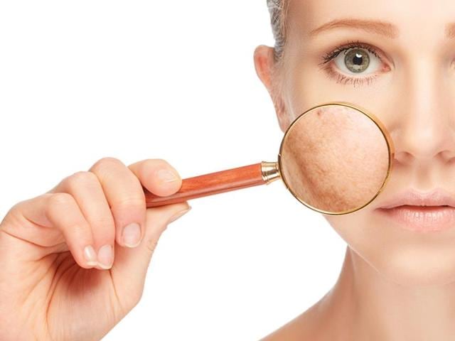 Here are some tips on how to get rid of pigmentation and other skin related problems. (Shutterstock) Here are some tips on how to get rid of pigmentation and other skin related problems. (Shutterstock)