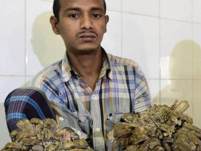 A Bangladeshi father dubbed “Tree Man” for massive bark-like warts on his hands and feet will finally have surgery to remove the growths that first began appearing 10 years ago,(AFP)