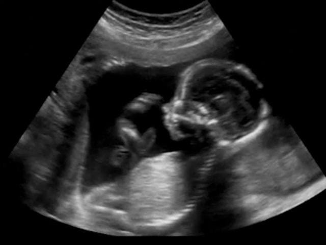 Despite a legislation that bans prenatal sex determination, the child sex ratio in India has come down to 918 in 2011 from 927 in 2001.(Picture courtesy: Shutterstock) Despite a legislation that bans prenatal sex determination, the child sex ratio in India has come down to 918 in 2011 from 927 in 2001.(Picture courtesy: Shutterstock)