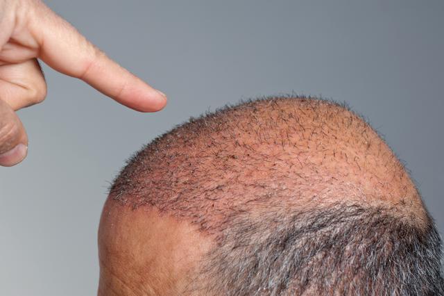 * Rs 25 per hair graft, 1000 hair grafts. (Shutterstock)