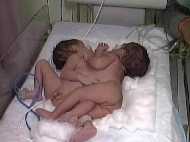 A woman gave birth to conjoined twins in Agra, Uttar Pradesh, on February 3, 2016.(ANI)