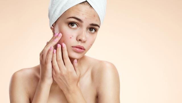 Sensitive skin may even see sudden rise of pimples. (Shutterstock)