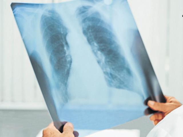 Cases of extensively drug-resistant tuberculosis (TB) are on the rise in India.(Representative image)