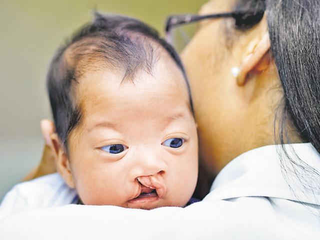The right age of treatment of a child with a cleft lip is six-months, and for a child with a cleft palate is one year. (IStock) The right age of treatment of a child with a cleft lip is six-months, and for a child with a cleft palate is one year. (IStock)